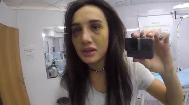 Марина Мексика после пластики носа