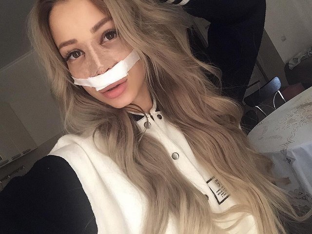 Екатерина Гужвинская: Как пережить пластику носа?
