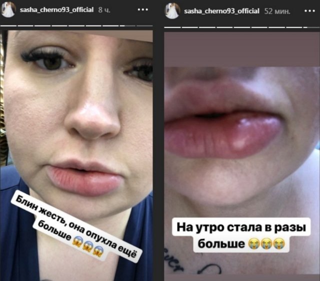 Саша Черно пострадала из-за уколов красоты