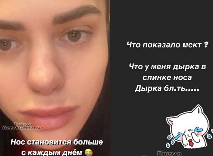 Анастасия Балинская: Что показало МСКТ?