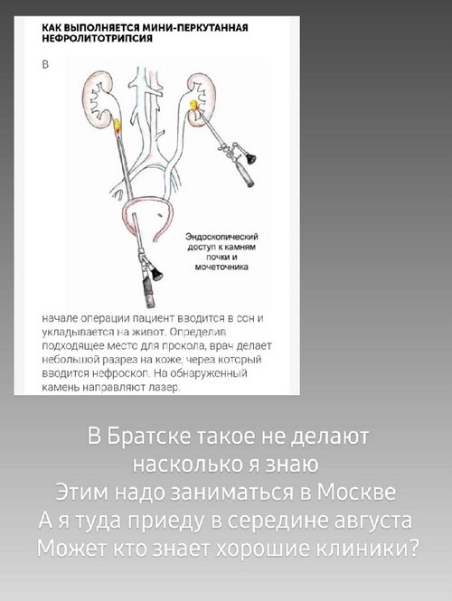 Ольга Ветер: Читаю про виды операций