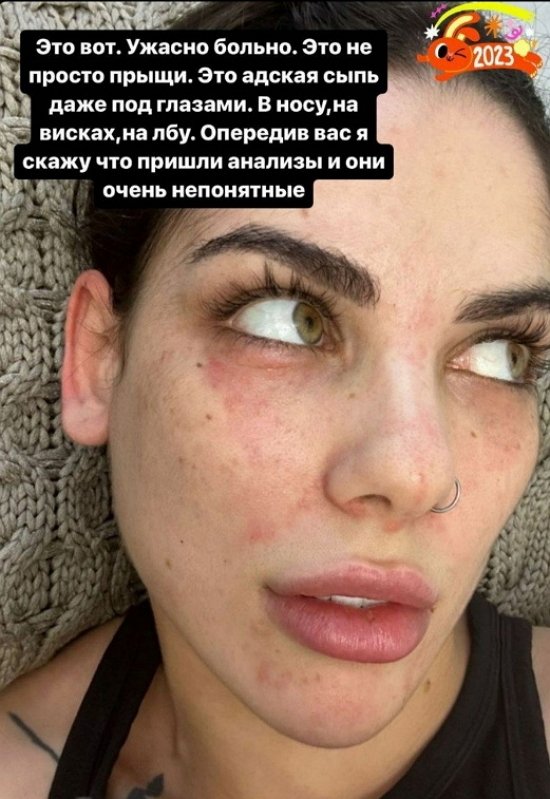 Алёна Опенченко: В носу, на висках, на лбу...