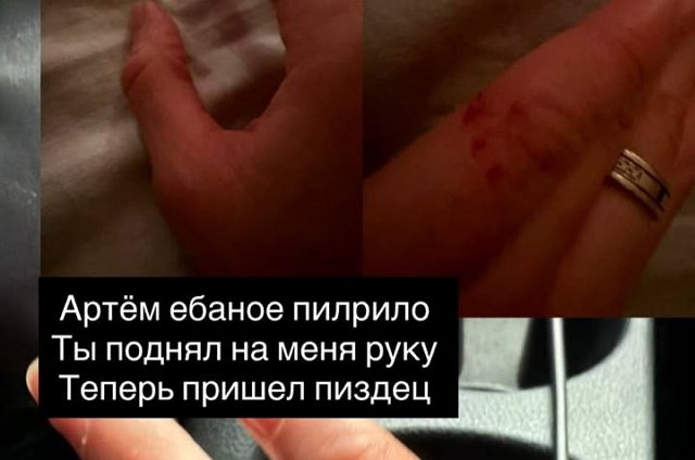 Анну Брянскую избил возлюбленный