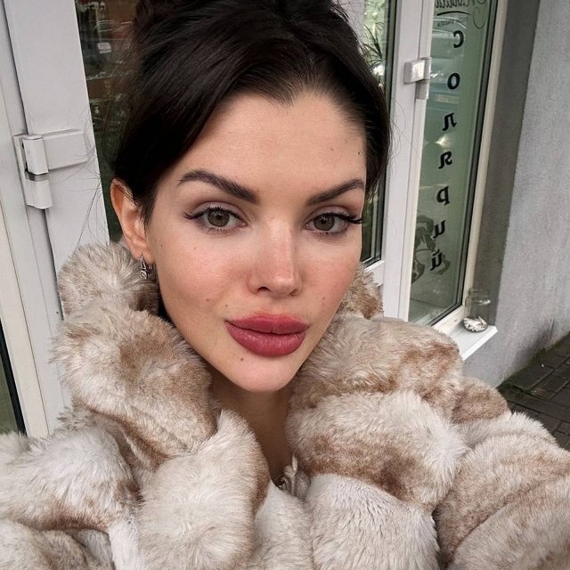 Анна Евстропова решила завязать с накачиванием больших губ Анна Евстропова решила завязать с накачиванием больших губ