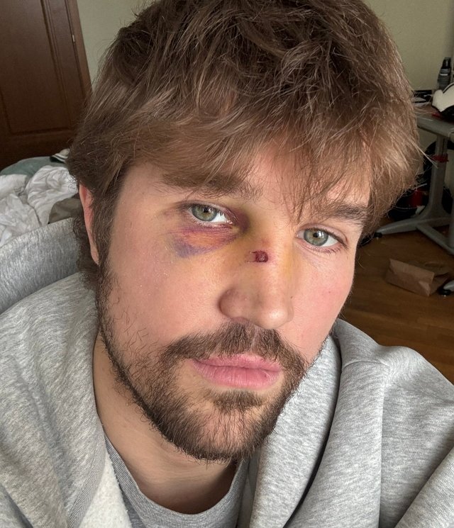 Роман Гриценко: По поводу синяка