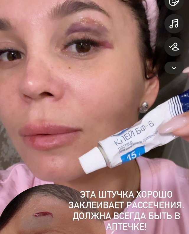 Юлия Колисниченко чуть не осталась без глаза